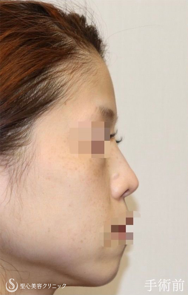 【30代女性・アップノーズを改善、直線的な鼻柱を自然なカーブに】鼻中隔延長（耳介軟骨移植）＋鼻尖形成（耳介軟骨移植）＋鼻背軟骨移植（耳介軟骨移植）＋他院修正（1年後） Before 
