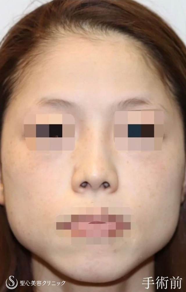 【30代女性・アップノーズを改善、直線的な鼻柱を自然なカーブに】鼻中隔延長（耳介軟骨移植）＋鼻尖形成（耳介軟骨移植）＋鼻背軟骨移植（耳介軟骨移植）＋他院修正（1年後） Before 