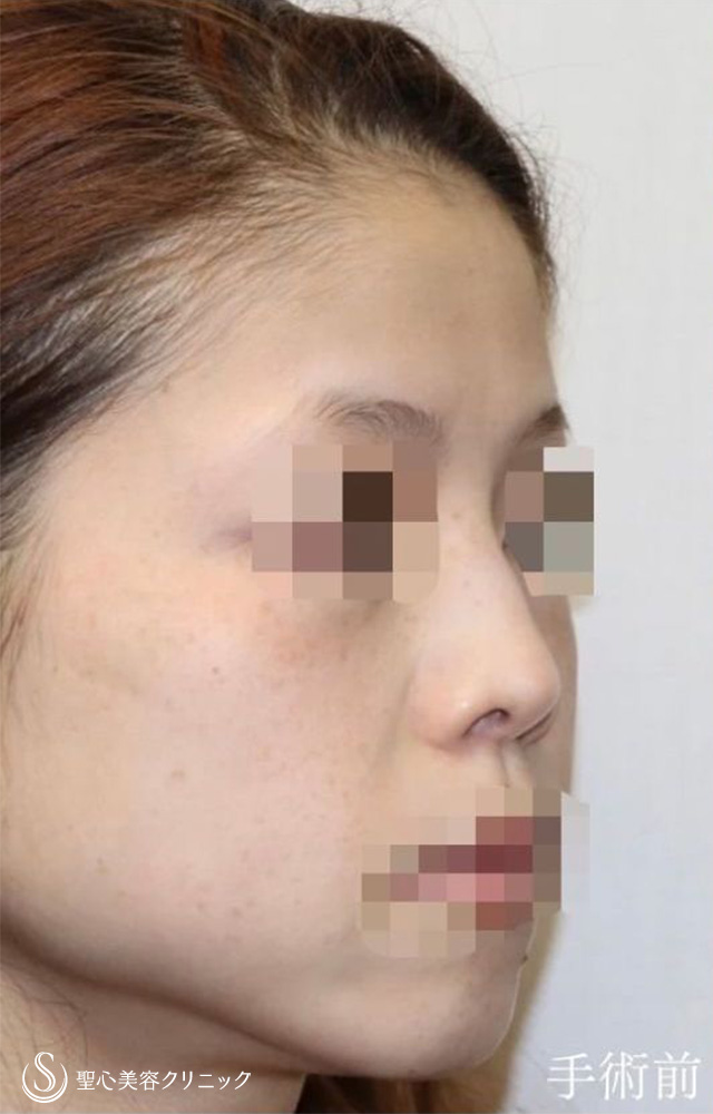 【30代女性・アップノーズを改善、直線的な鼻柱を自然なカーブに】鼻中隔延長（耳介軟骨移植）＋鼻尖形成（耳介軟骨移植）＋鼻背軟骨移植（耳介軟骨移植）＋他院修正（1年後） Before 