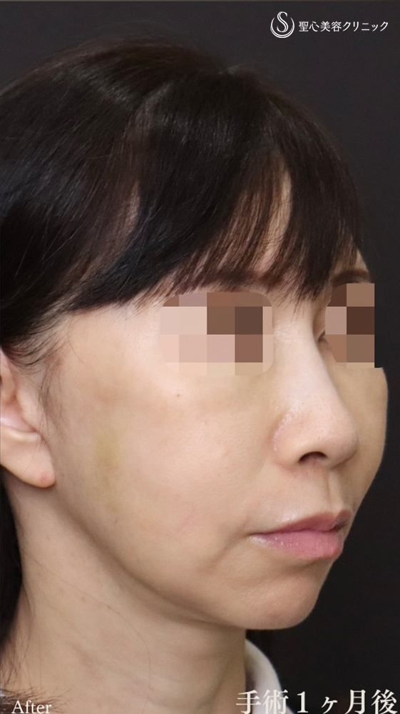【50代女性・フェイスリフト効果を最大限に、持続力も最大限に】フェイスリフト＋顎下、頬の脂肪吸引＋リガメント処置（1ヶ月後） After 