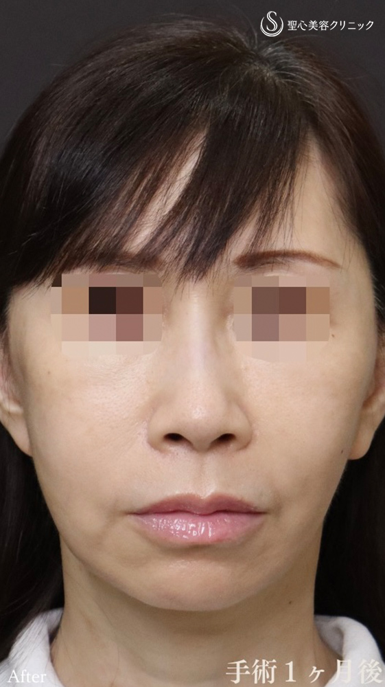 【50代女性・フェイスリフト効果を最大限に、持続力も最大限に】フェイスリフト＋顎下、頬の脂肪吸引＋リガメント処置（1ヶ月後） After 