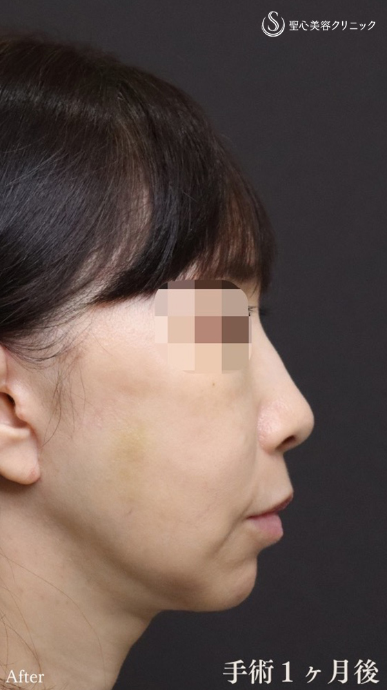 【50代女性・フェイスリフト効果を最大限に、持続力も最大限に】フェイスリフト＋顎下、頬の脂肪吸引＋リガメント処置（1ヶ月後） After 