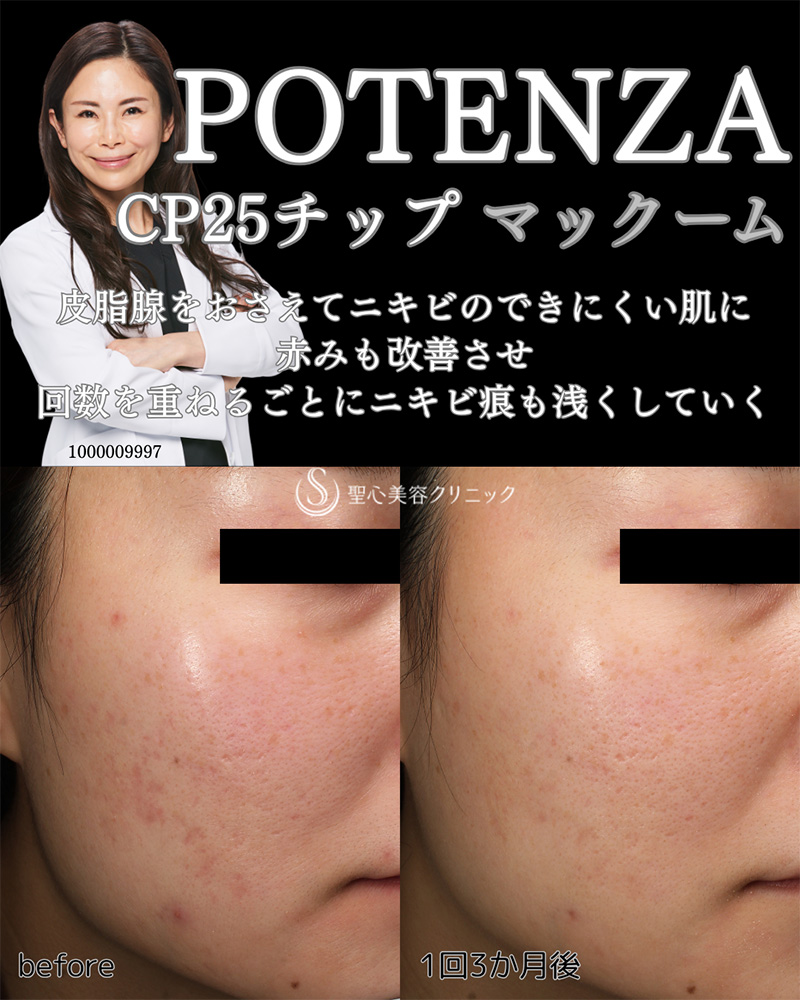 【20代女性・ニキビ】POTENZA（ポテンツァ）＋McCoom（マックーム）（1回後） After 