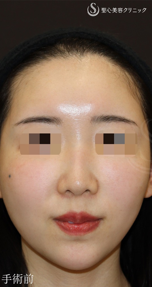 【30代女性・丸い鼻先をシュンとして美鼻に】鼻尖形成（耳介軟骨移植）＋ストラット法（1年後） Before 