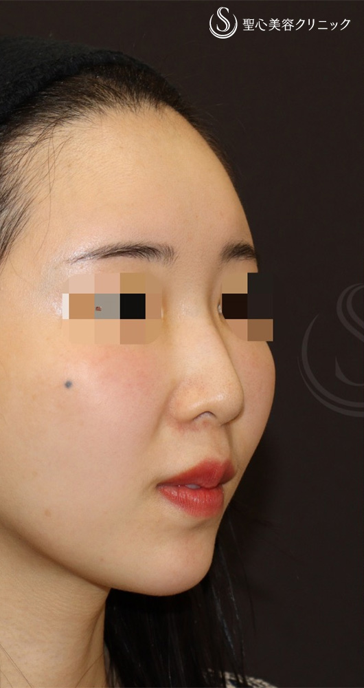 【30代女性・丸い鼻先をシュンとして美鼻に】鼻尖形成（耳介軟骨移植）＋ストラット法（1年後） Before 