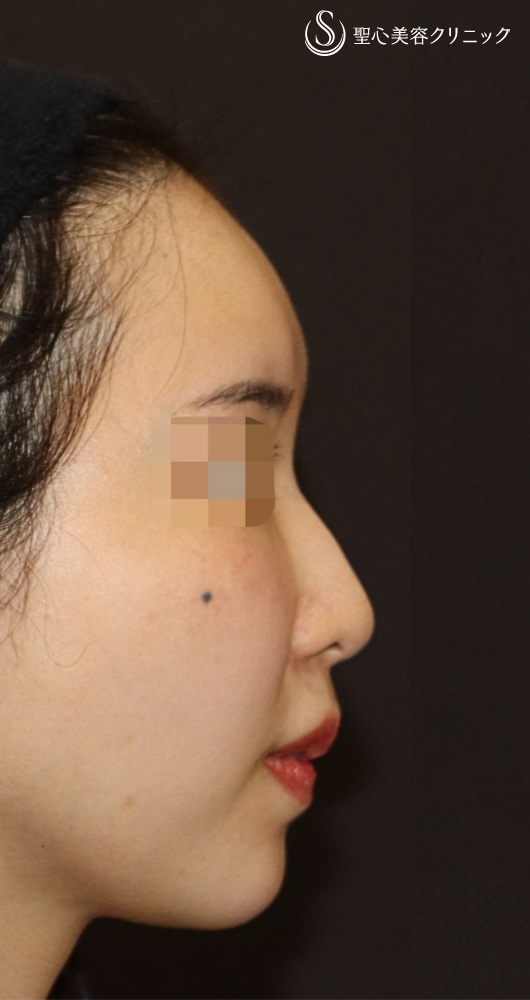 【30代女性・丸い鼻先をシュンとして美鼻に】鼻尖形成（耳介軟骨移植）＋ストラット法（1年後） Before 