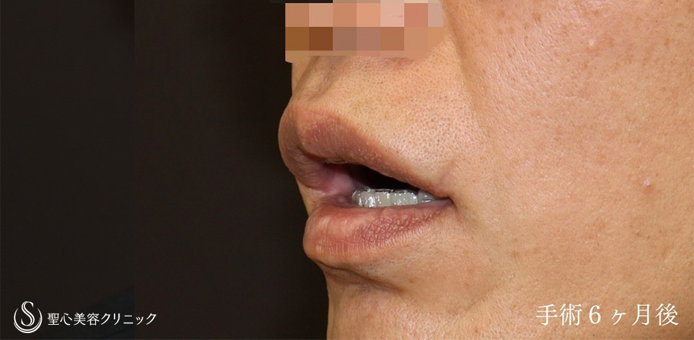【40代男性・口角をナチュラルに戻す】他院口角挙上後の高度修正（6ヶ月後） After 
