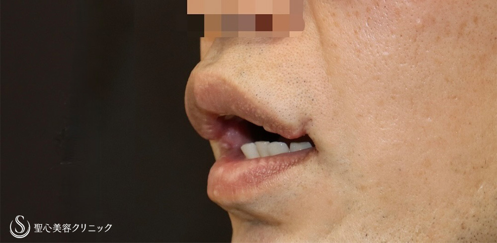 【40代男性・口角をナチュラルに戻す】他院口角挙上後の高度修正（6ヶ月後） Before 