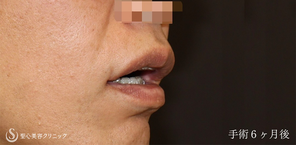 【40代男性・口角をナチュラルに戻す】他院口角挙上後の高度修正（6ヶ月後） After 