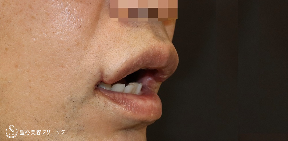 【40代男性・口角をナチュラルに戻す】他院口角挙上後の高度修正（6ヶ月後） Before 
