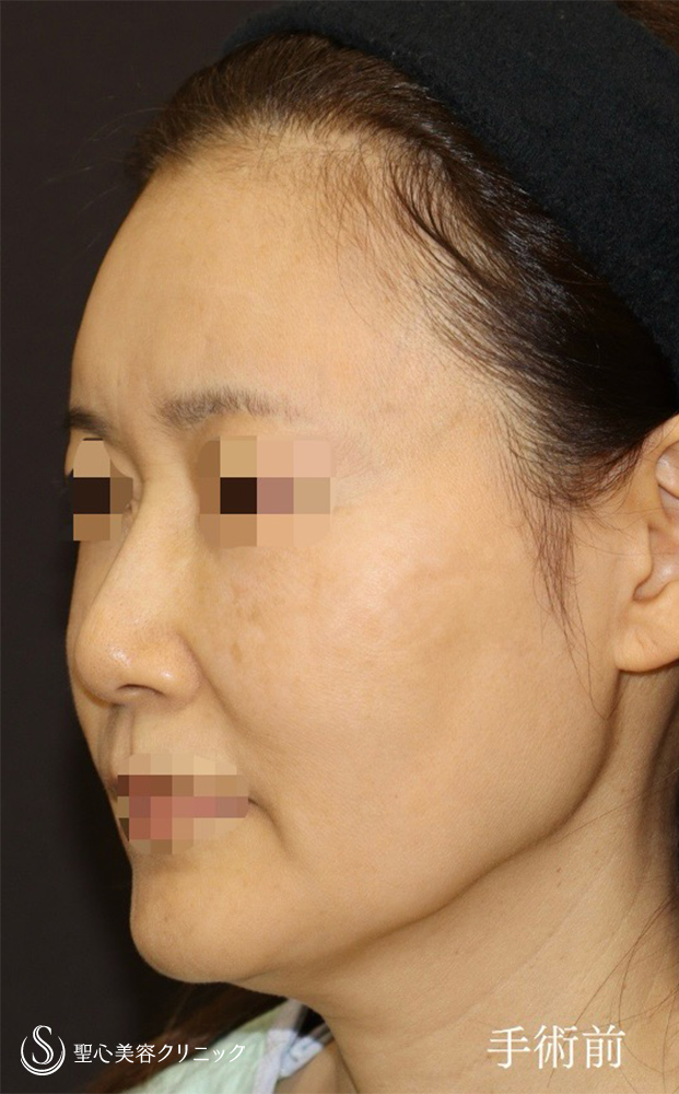 【50代女性・フェイスラインもあご下もオデコも若々しく】フェイスリフト＋前額リフト（2ヶ月後） Before 