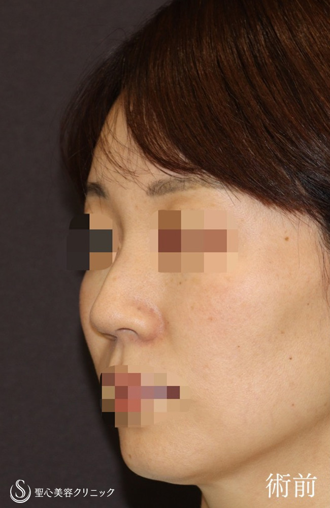 【40代女性・鼻の幅、高さ、ACRを整える】鼻尖縮小＋鼻尖形成（耳介軟骨移植）＋ストラット法＋鼻柱形成（鼻柱下降術）（1週間後） Before 