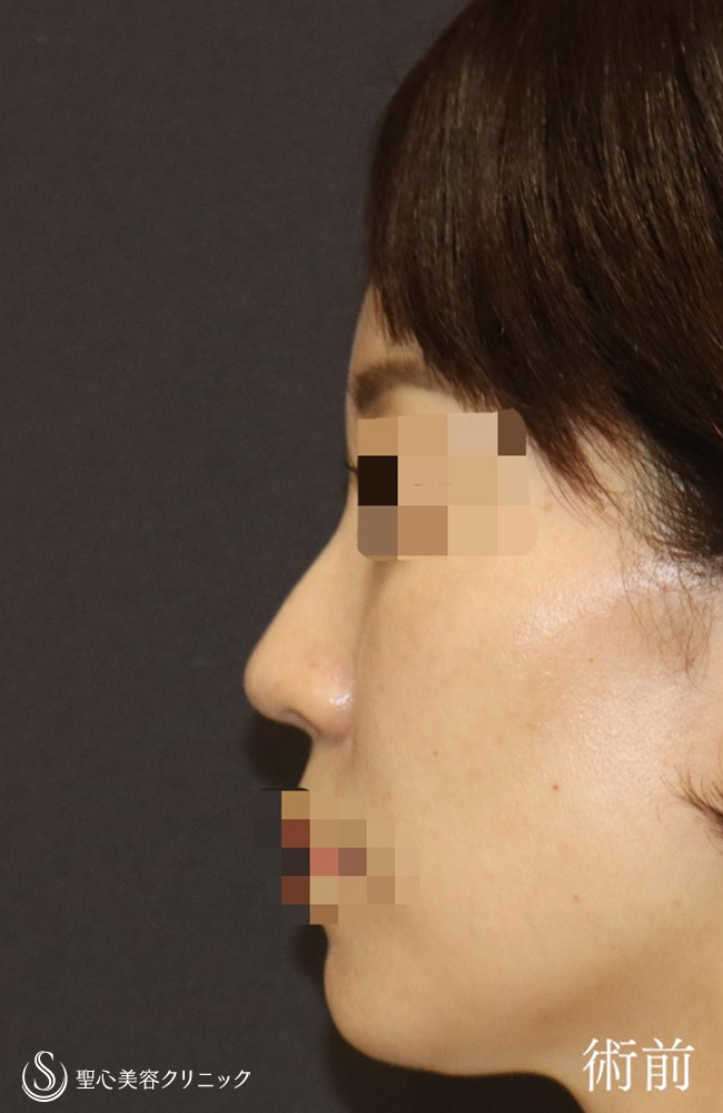 【40代女性・鼻の幅、高さ、ACRを整える】鼻尖縮小＋鼻尖形成（耳介軟骨移植）＋ストラット法＋鼻柱形成（鼻柱下降術）（1週間後） Before 