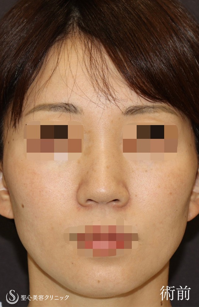 【40代女性・鼻の幅、高さ、ACRを整える】鼻尖縮小＋鼻尖形成（耳介軟骨移植）＋ストラット法＋鼻柱形成（鼻柱下降術）（1週間後） Before 