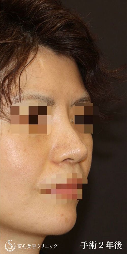 【40代女性・皮膚が厚く硬い方も綺麗にスッキリと】鼻中隔延長術（肋軟骨）＋鼻尖形成（耳介軟骨移植）＋プロテーゼ入替（2年後） After 