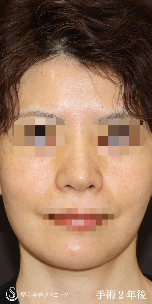 【40代女性・皮膚が厚く硬い方も綺麗にスッキリと】鼻中隔延長術（肋軟骨）＋鼻尖形成（耳介軟骨移植）＋プロテーゼ入替（2年後） After 