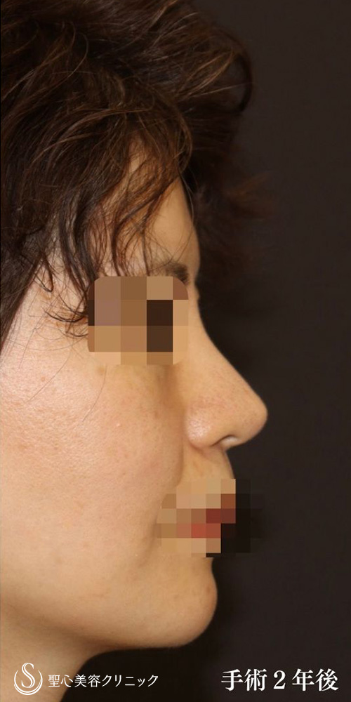 【40代女性・皮膚が厚く硬い方も綺麗にスッキリと】鼻中隔延長術（肋軟骨）＋鼻尖形成（耳介軟骨移植）＋プロテーゼ入替（2年後） After 