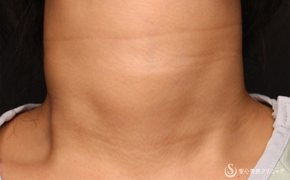 【20代女性・首のしわ】プレミアムPRP皮膚再生療法（6ヶ月後） After 