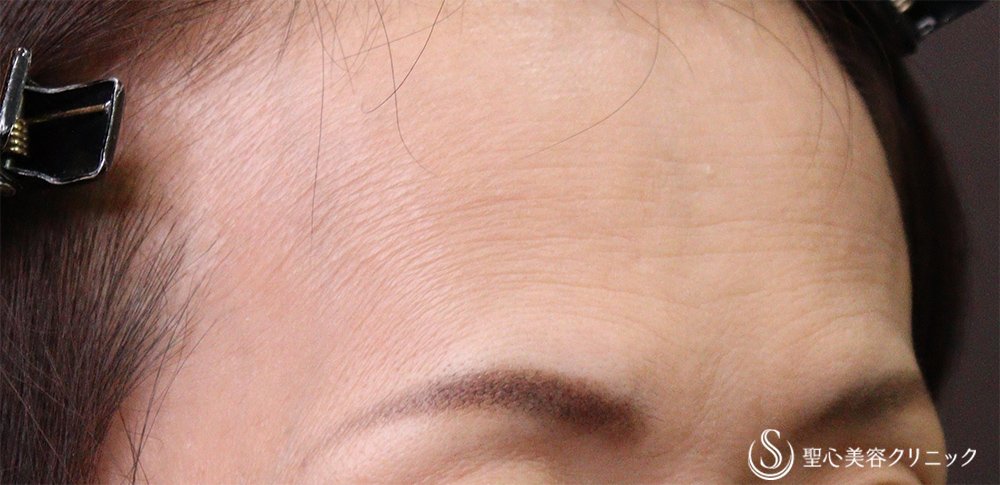 【50代女性・額のしわ】プレミアムPRP皮膚再生療法（3ヶ月後） After 