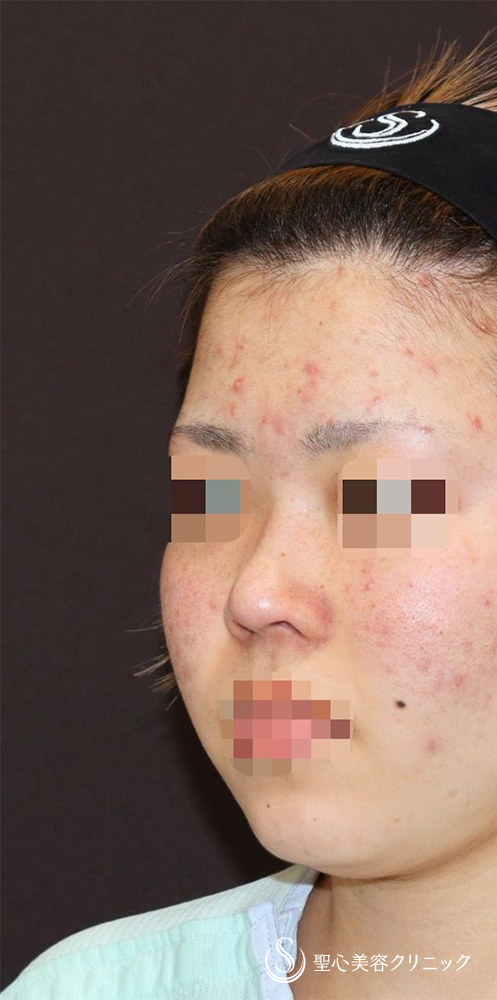 【20代女性・ACR、鼻筋を整えて美人に】他院修正＋鼻中隔延長（肋軟骨）＋ 鼻中隔延長（肋軟骨）＋オーダーメイドプロテーゼ（1週間後） Before 