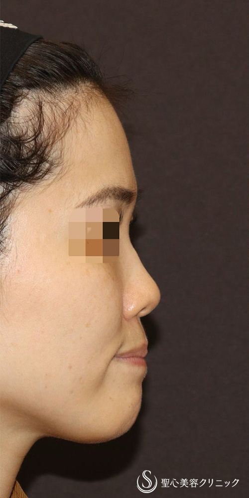 【20代女性・忘れ鼻（美鼻）形成】鼻中隔延長（肋軟骨移植）＋鼻尖形成（肋軟骨移植）＋オーダーメイドプロテーゼ（6ヶ月後） Before 