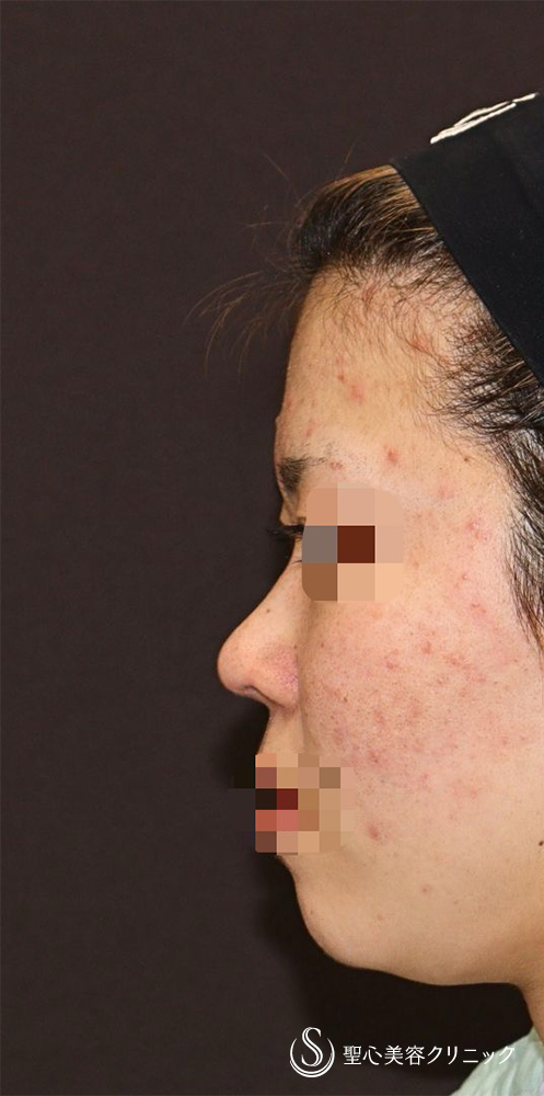 【20代女性・ACR、鼻筋を整えて美人に】他院修正＋鼻中隔延長（肋軟骨）＋ 鼻中隔延長（肋軟骨）＋オーダーメイドプロテーゼ（1週間後） Before 