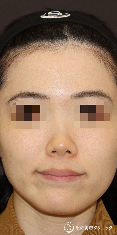 【20代女性・忘れ鼻（美鼻）形成】鼻中隔延長（肋軟骨移植）＋鼻尖形成（肋軟骨移植）＋オーダーメイドプロテーゼ（6ヶ月後） Before 