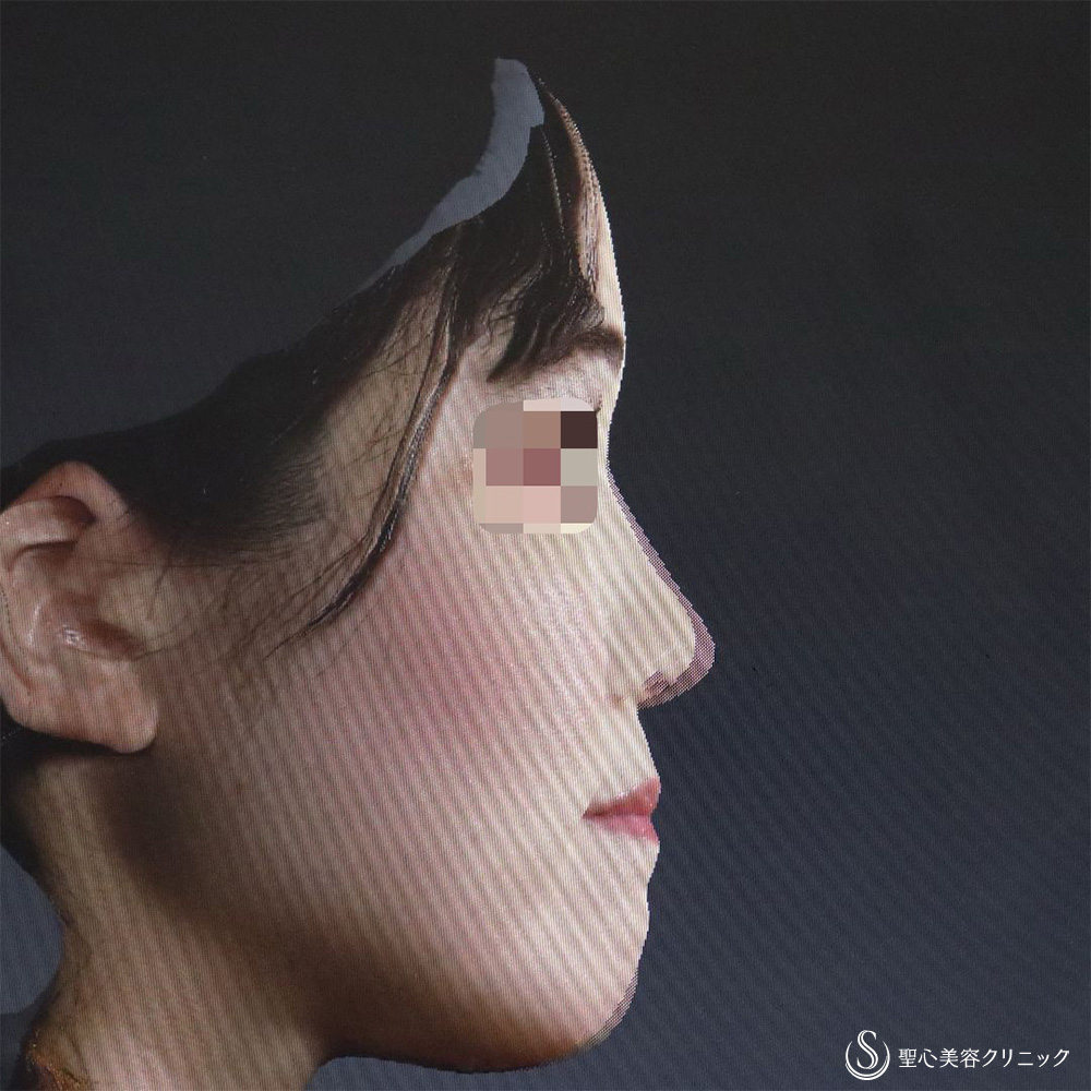 【20代女性・忘れ鼻（美鼻）形成】鼻中隔延長（肋軟骨移植）＋鼻尖形成（肋軟骨移植）＋オーダーメイドプロテーゼ（6ヶ月後） Before 