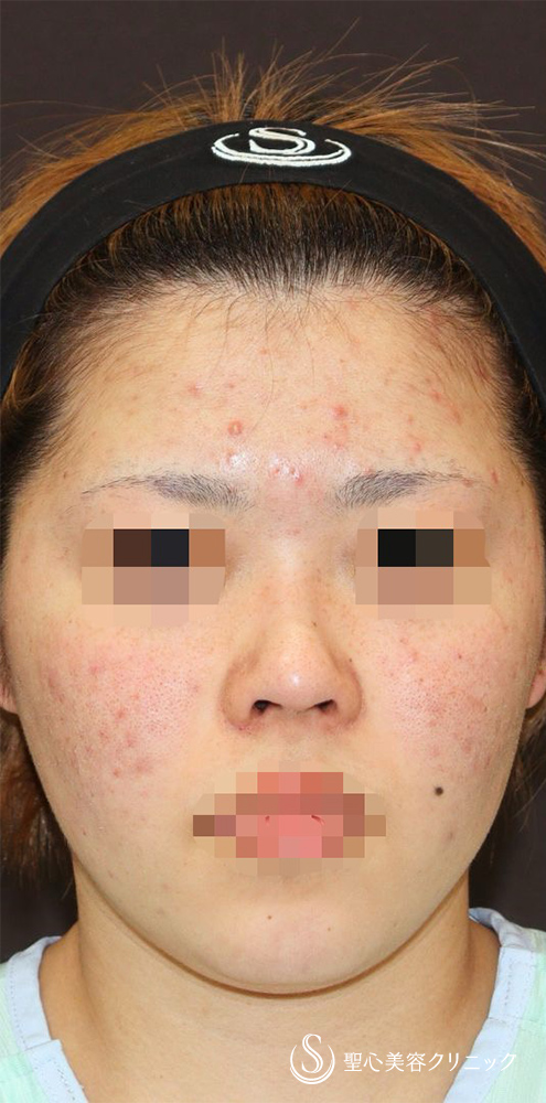 【20代女性・ACR、鼻筋を整えて美人に】他院修正＋鼻中隔延長（肋軟骨）＋ 鼻中隔延長（肋軟骨）＋オーダーメイドプロテーゼ（1週間後） Before 