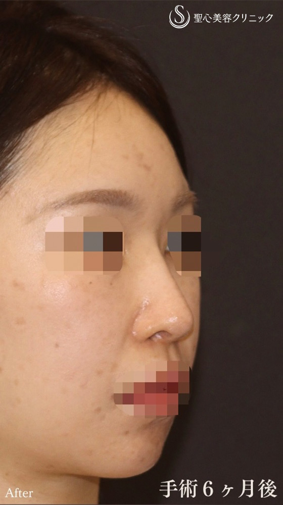【30代女性・鼻の曲がり、ACR、鼻の高さを改善し美鼻に】鼻中隔延長（耳介軟骨移植）＋鼻尖形成（耳介軟骨移植）＋オーダーメイドプロテーゼ＋他院修正（6ヶ月後） After 