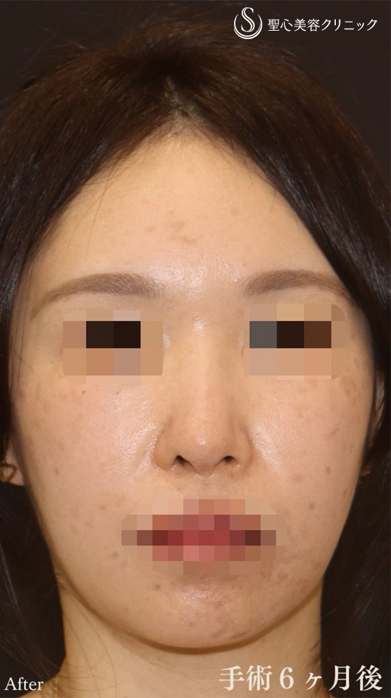 【30代女性・鼻の曲がり、ACR、鼻の高さを改善し美鼻に】鼻中隔延長（耳介軟骨移植）＋鼻尖形成（耳介軟骨移植）＋オーダーメイドプロテーゼ＋他院修正（6ヶ月後） After 