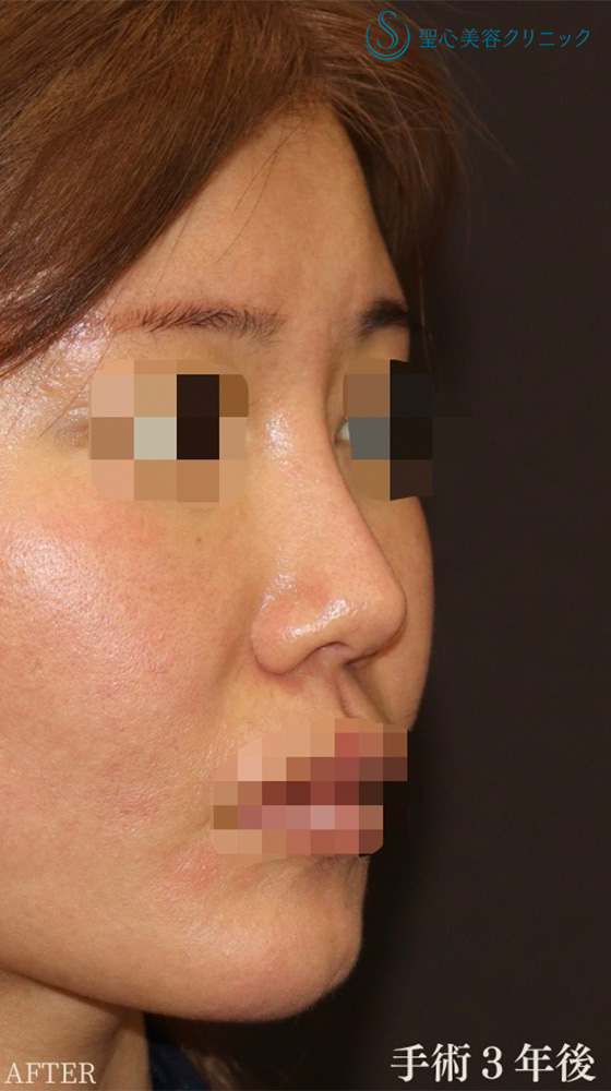 【30代女性・直線化した鼻柱を自然なカーブに】鼻中隔延長（耳介軟骨移植）＋鼻尖形成（耳介軟骨移植）＋プロテーゼ入替＋他院修正（3年後） After 