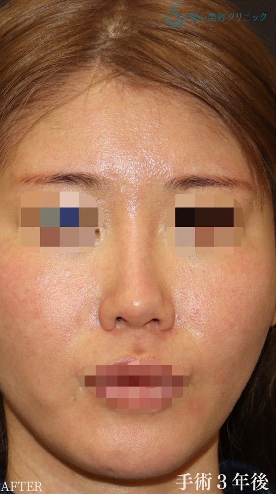 【30代女性・直線化した鼻柱を自然なカーブに】鼻中隔延長（耳介軟骨移植）＋鼻尖形成（耳介軟骨移植）＋プロテーゼ入替＋他院修正（3年後） After 