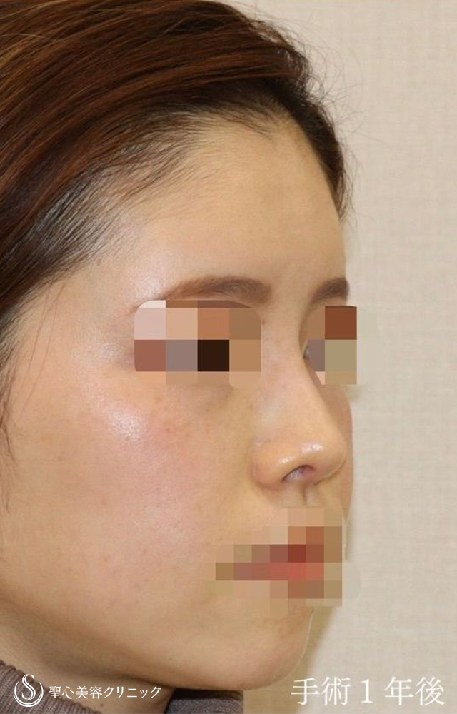 【30代女性・アップノーズを改善、直線的な鼻柱を自然なカーブに】鼻中隔延長（耳介軟骨移植）＋鼻尖形成（耳介軟骨移植）＋鼻背軟骨移植（耳介軟骨移植）＋他院修正（1年後） After 