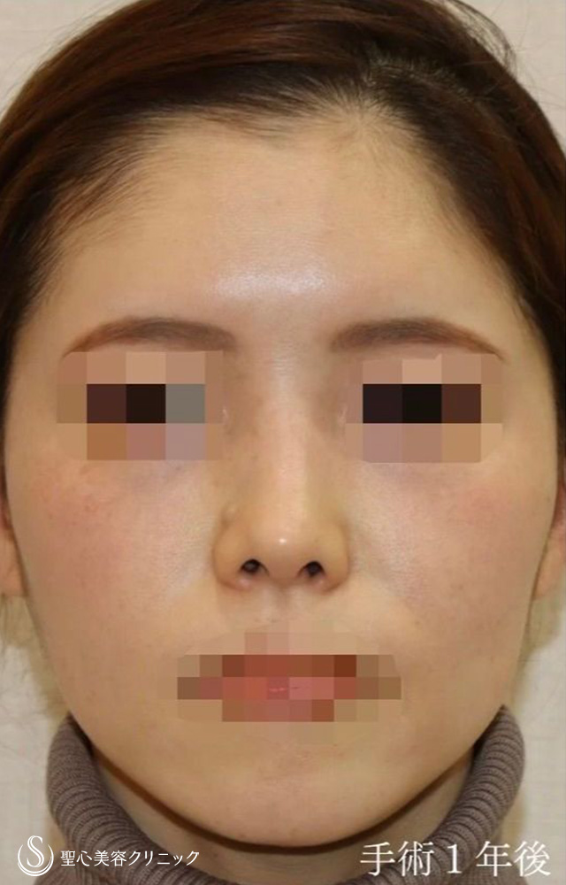 【30代女性・アップノーズを改善、直線的な鼻柱を自然なカーブに】鼻中隔延長（耳介軟骨移植）＋鼻尖形成（耳介軟骨移植）＋鼻背軟骨移植（耳介軟骨移植）＋他院修正（1年後） After 