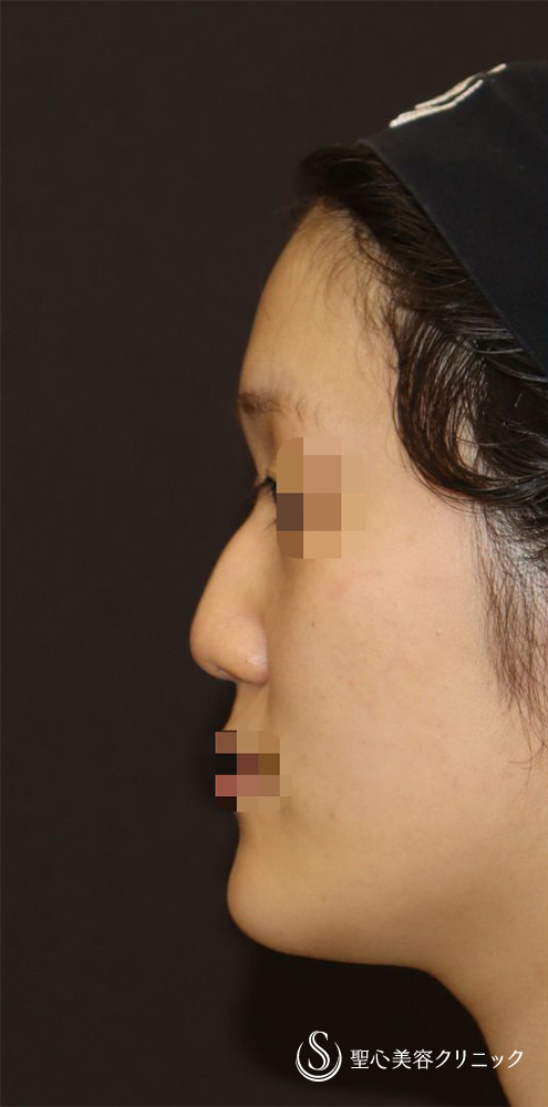 【20代女性・美鼻形成でお顔全体をも美人に】鼻中隔延長（肋軟骨）＋鼻尖形成＋鼻背軟骨移植＋鼻根部ダイス移植（肋軟骨）（2ヶ月後） Before 