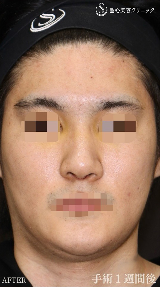 【20代男性・鼻フル後1週間で美男子鼻に】鼻中隔延長（耳介軟骨移植）＋鼻尖形成（耳介軟骨移植）＋鼻背軟骨移植（耳介軟骨移植）（1週間後） After 