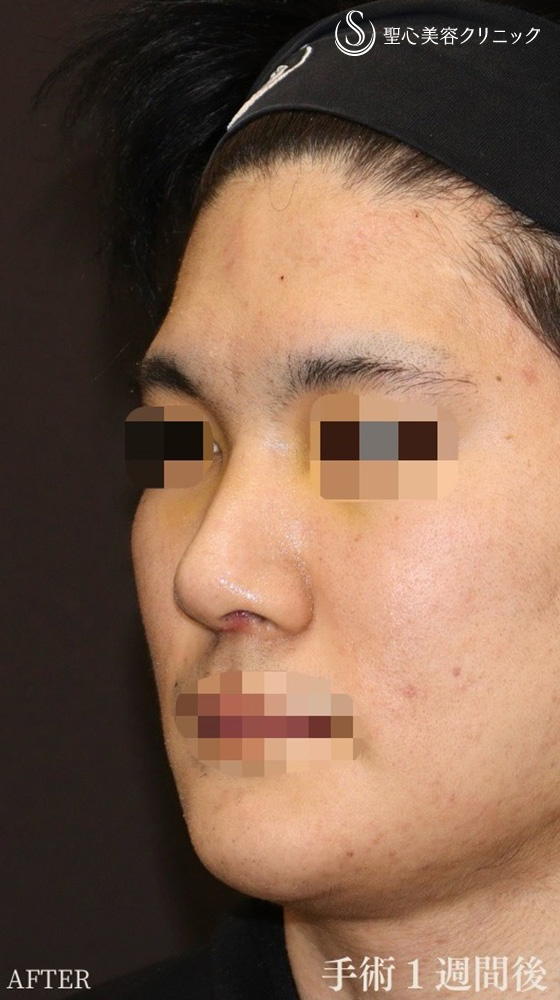 【20代男性・鼻フル後1週間で美男子鼻に】鼻中隔延長（耳介軟骨移植）＋鼻尖形成（耳介軟骨移植）＋鼻背軟骨移植（耳介軟骨移植）（1週間後） After 
