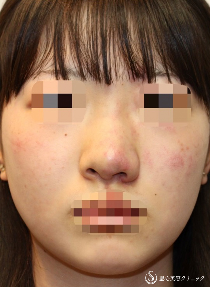 【10代女性・他院修正で鼻の左右差を目立たなく】他院修正＋鼻翼縮小＋鼻翼挙上術（2ヶ月後） Before 