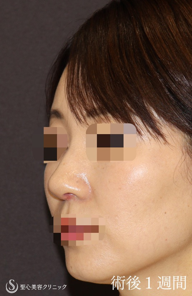【40代女性・鼻の幅、高さ、ACRを整える】鼻尖縮小＋鼻尖形成（耳介軟骨移植）＋ストラット法＋鼻柱形成（鼻柱下降術）（1週間後） After 
