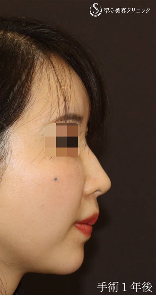 【30代女性・丸い鼻先をシュンとして美鼻に】鼻尖形成（耳介軟骨移植）＋ストラット法（1年後） After 