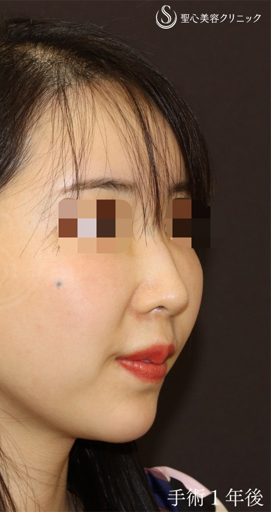 【30代女性・丸い鼻先をシュンとして美鼻に】鼻尖形成（耳介軟骨移植）＋ストラット法（1年後） After 