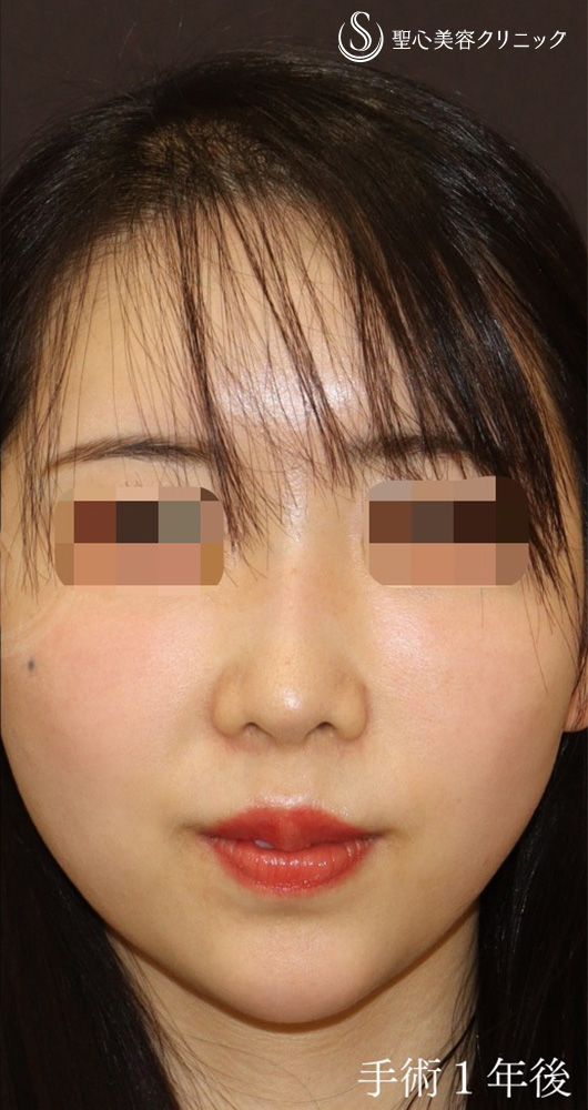 【30代女性・丸い鼻先をシュンとして美鼻に】鼻尖形成（耳介軟骨移植）＋ストラット法（1年後） After 