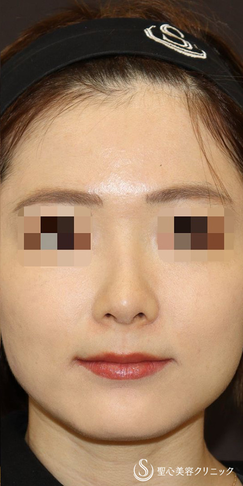 【20代女性・忘れ鼻（美鼻）形成】鼻中隔延長（肋軟骨移植）＋鼻尖形成（肋軟骨移植）＋オーダーメイドプロテーゼ（6ヶ月後） After 