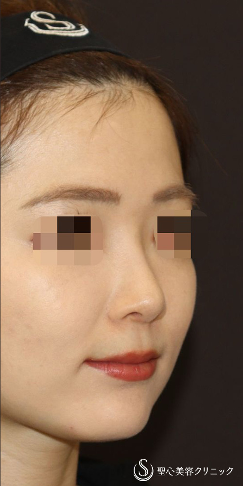 【20代女性・忘れ鼻（美鼻）形成】鼻中隔延長（肋軟骨移植）＋鼻尖形成（肋軟骨移植）＋オーダーメイドプロテーゼ（6ヶ月後） After 
