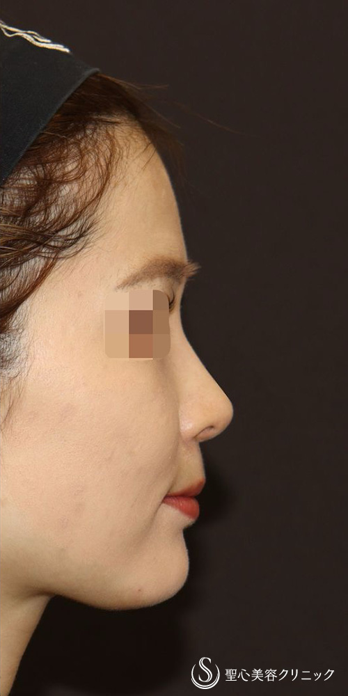 【20代女性・忘れ鼻（美鼻）形成】鼻中隔延長（肋軟骨移植）＋鼻尖形成（肋軟骨移植）＋オーダーメイドプロテーゼ（6ヶ月後） After 