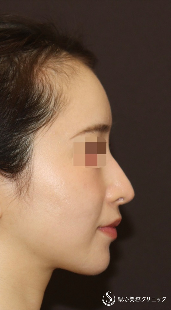 【20代女性・ドロップした鼻先を高くして美鼻に】他院修正＋鼻尖縮小＋鼻尖形成（耳介軟骨）＋ストラット法（耳介軟骨）（1年後） After 