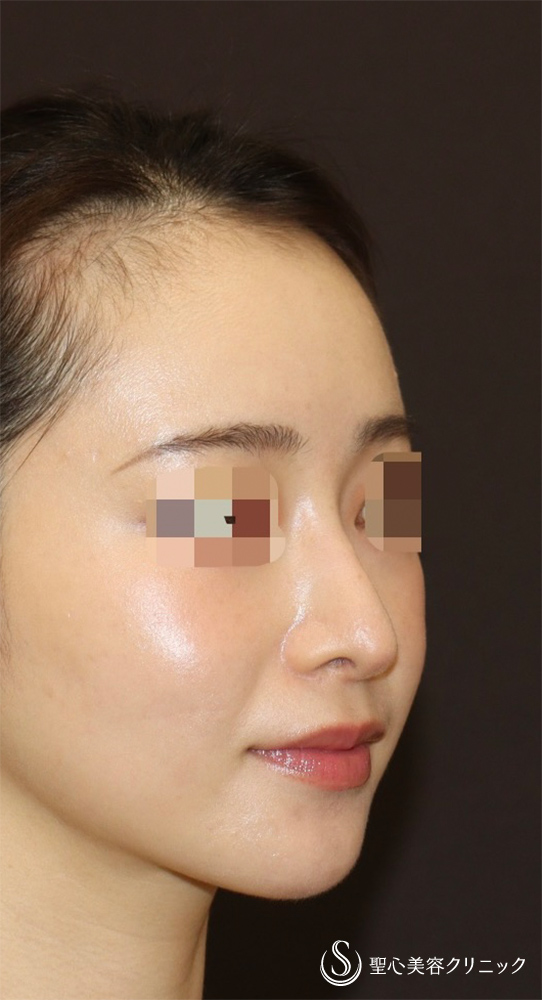 【20代女性・ドロップした鼻先を高くして美鼻に】他院修正＋鼻尖縮小＋鼻尖形成（耳介軟骨）＋ストラット法（耳介軟骨）（1年後） After 