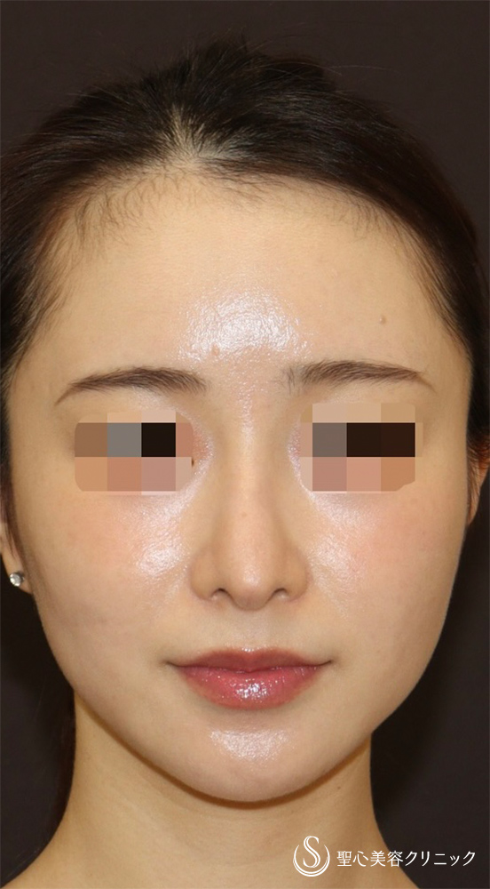 【20代女性・ドロップした鼻先を高くして美鼻に】他院修正＋鼻尖縮小＋鼻尖形成（耳介軟骨）＋ストラット法（耳介軟骨）（1年後） After 