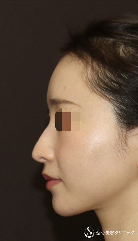 【20代女性・ドロップした鼻先を高くして美鼻に】他院修正＋鼻尖縮小＋鼻尖形成（耳介軟骨）＋ストラット法（耳介軟骨）（1年後） After 